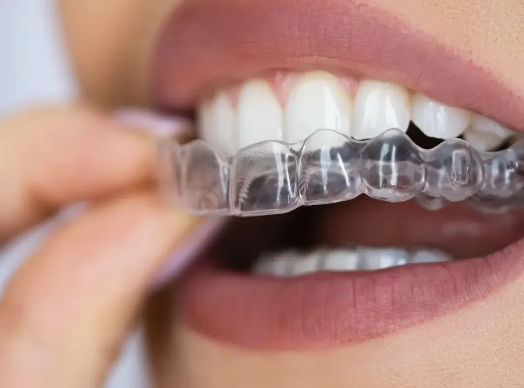 654b17f4a2fcfc932ebf32e7_sorriso-perfeito-invisalign-1200x1200